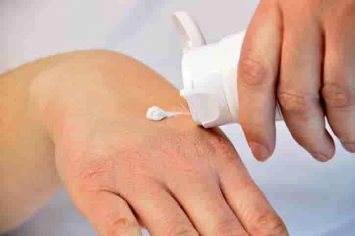 How to Get Rid of Redness from Tingle Lotion